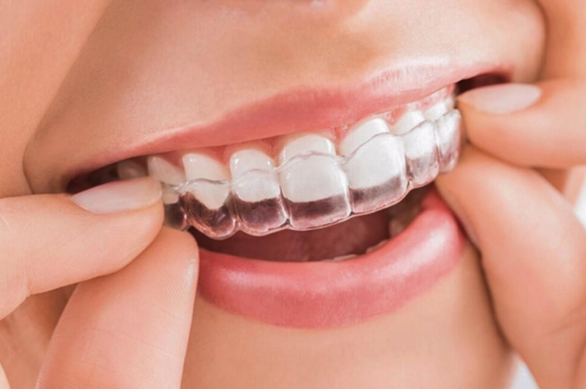 Niềng răng trong suốt Invisalign đảm bảo thẩm mỹ trong quá trình niềng (Nguồn: St)